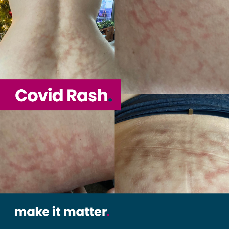 ashmedcomms's tweet photo. LisaMarie tested positive for #coronavirus on October 26th, 2020, and since then, her life hasn’t been the same. Long covid, heart failure, breathing retraining and a total of 36 tablets per day has become her new norm.

Read more about her story below...

#covid19 #longcovid