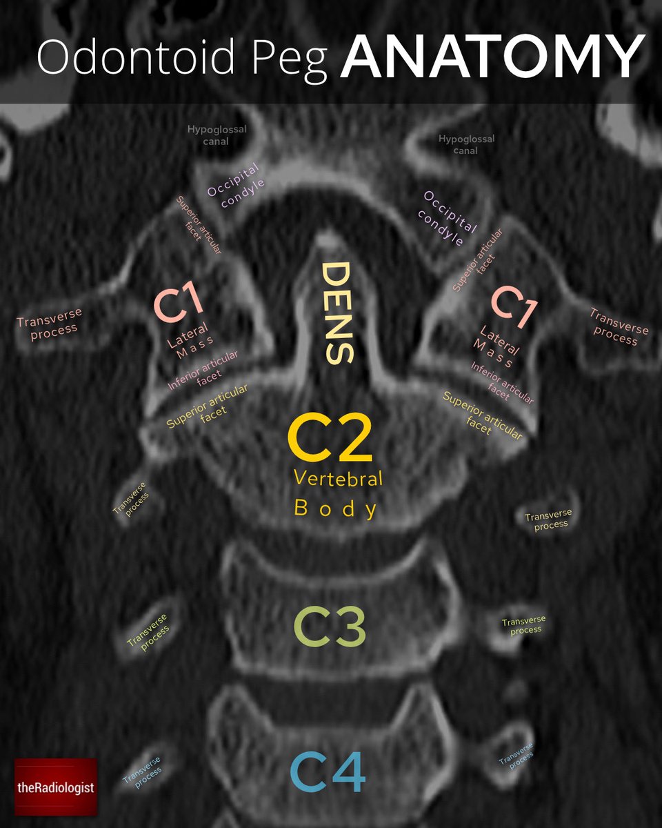 radiologistpage's tweet photo. Anderson and D'Alonzo classification of odontoid peg fracture https://t.co/WKvJoo7Uns