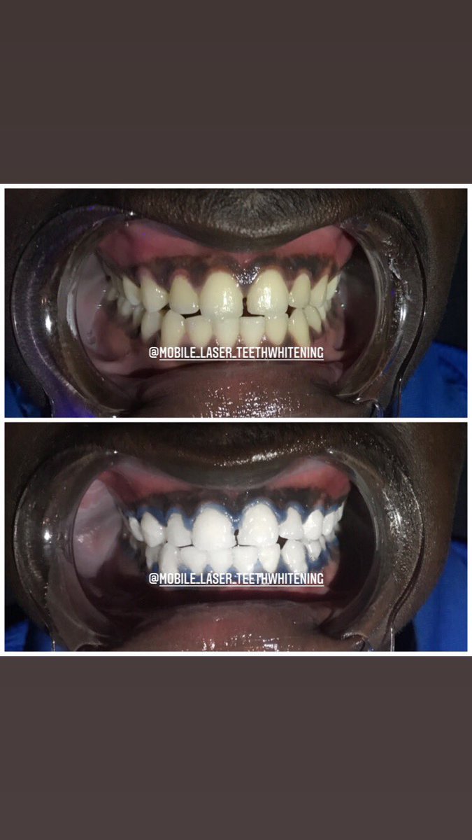 PremierTeeth's tweet photo. 𝐄𝐍𝐉𝐎𝐘 𝟐𝟓% 𝐌𝐎𝐑𝐄 𝐒𝐄𝐒𝐒𝐈𝐎𝐍𝐒 𝐖𝐇𝐄𝐍 𝐘𝐎𝐔 𝐃𝐎 𝟔 𝐒𝐄𝐒𝐒𝐈𝐎𝐍𝐒 𝐎𝐑 𝐌𝐎𝐑𝐄 

𝐖𝐡𝐚𝐭𝐬𝐀𝐩𝐩, 𝐂𝐚𝐥𝐥 𝐨𝐫 𝐃𝐌 𝐮𝐬 𝐍𝐎𝐖 
📲𝟎𝟐𝟎𝟑𝟖𝟕𝟏𝟓𝟒𝟓 

#𝐩𝐫𝐨𝐦𝐨 
#𝐝𝐢𝐬𝐜𝐨𝐮𝐧𝐭 
#𝐰𝐡𝐢𝐭𝐞𝐭𝐞𝐞𝐭𝐡 https://t.co/D9oRImdUSf