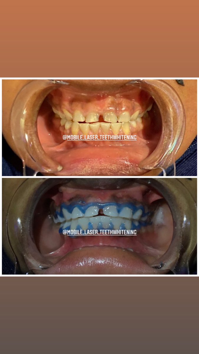 PremierTeeth's tweet photo. 𝐄𝐍𝐉𝐎𝐘 𝟐𝟓% 𝐌𝐎𝐑𝐄 𝐒𝐄𝐒𝐒𝐈𝐎𝐍𝐒 𝐖𝐇𝐄𝐍 𝐘𝐎𝐔 𝐃𝐎 𝟔 𝐒𝐄𝐒𝐒𝐈𝐎𝐍𝐒 𝐎𝐑 𝐌𝐎𝐑𝐄 

𝐖𝐡𝐚𝐭𝐬𝐀𝐩𝐩, 𝐂𝐚𝐥𝐥 𝐨𝐫 𝐃𝐌 𝐮𝐬 𝐍𝐎𝐖 
📲𝟎𝟐𝟎𝟑𝟖𝟕𝟏𝟓𝟒𝟓 

#𝐩𝐫𝐨𝐦𝐨 
#𝐝𝐢𝐬𝐜𝐨𝐮𝐧𝐭 
#𝐰𝐡𝐢𝐭𝐞𝐭𝐞𝐞𝐭𝐡 https://t.co/D9oRImdUSf