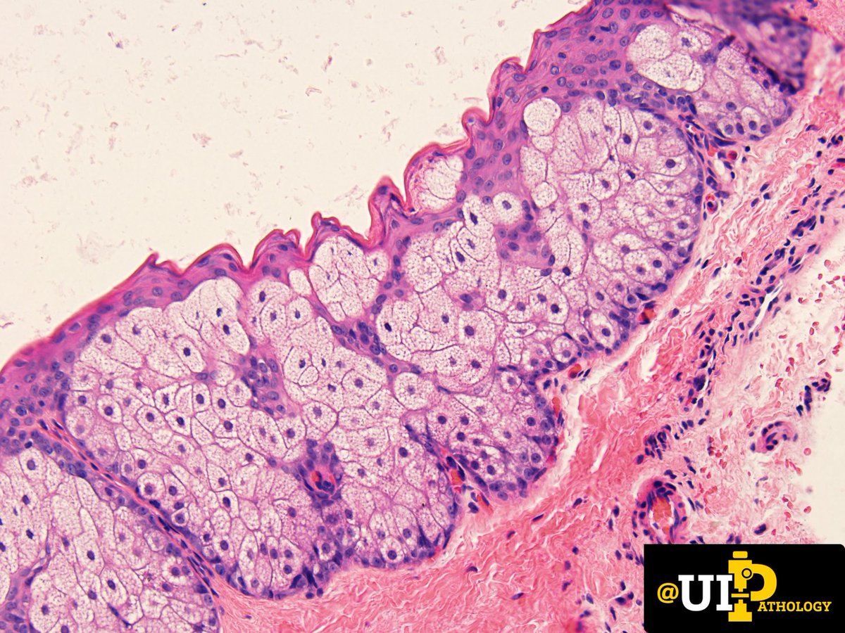 Adult with multiple subcutaneous nodules on the torso. What is your diagnosis?
#IowaPath #DermPath #CuteCaseConference