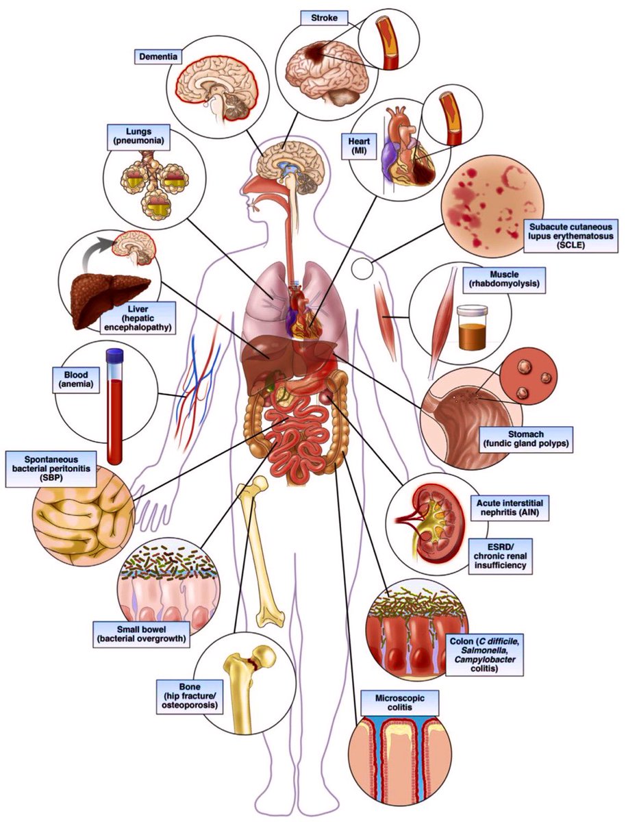 Paul_Wischmeyer's tweet photo. Potential Complications of Proton Pump Inhibitors 💊 (PPIs) #MedEd #MedTwitter 

https://t.co/b2J0ydcfrX
H/T @drkeithsiau https://t.co/RNApXaBw44
