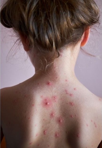 speciallymeco's tweet photo. Are you worried about getting acne? For Skin health month, we discuss some important facts about pregnancy acne, as well as how you can treat acne during your pregnancy.
https://t.co/EtlWxwFYMF https://t.co/T5ayjPrETc