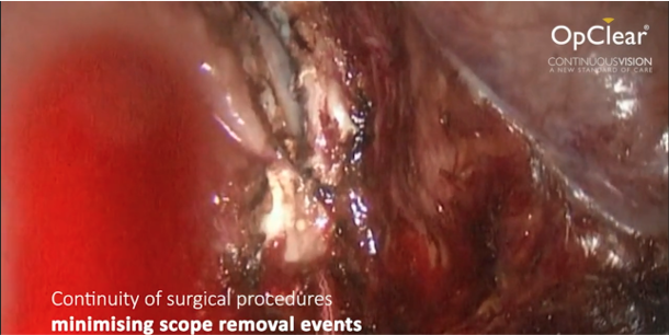 Cipher_Surgical's tweet photo. OpClear’s in-situ on demand CO2 and saline lens wash rapidly clears larger visual obstructions such as blood or particles from energy plumes, providing continuous vision throughout each procedure.
#continuousvision #claritycontrolcontinuity #OpClear https://t.co/qZXm7yF938