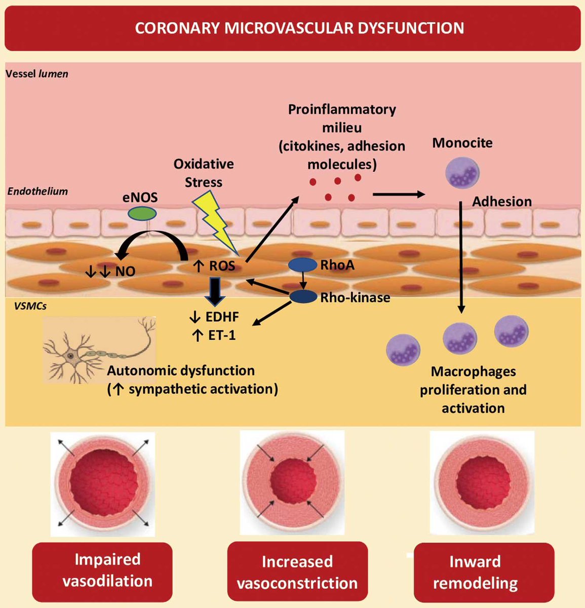 Medtorek's tweet photo. Pathophysiology of Coronary Microvascular Dysfunction
👉 Cardiovascular Risk Factors and CMD
Via #CirculationJournal 🇯🇵
⚓️ https://t.co/0WX4u2iNnZ
#CardioTwitter
@albertvaccaro21 @chichodisanto @josejgdnews @josejgdnews @KardiologieHH https://t.co/jVllRkOwbq