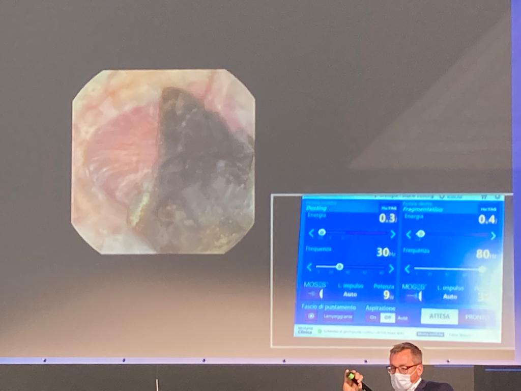 Congratulations to Dr. Mazzon at #TnT2021 for outstandingly performing a dusting and popcorn in a challenging RIRS (12 mm, 1030 HU) with a fragile patient. Once again #MOSESTech Distance Mode as a landmark for efficiency, versatility and safety. @LumenisU #Lithotripsy