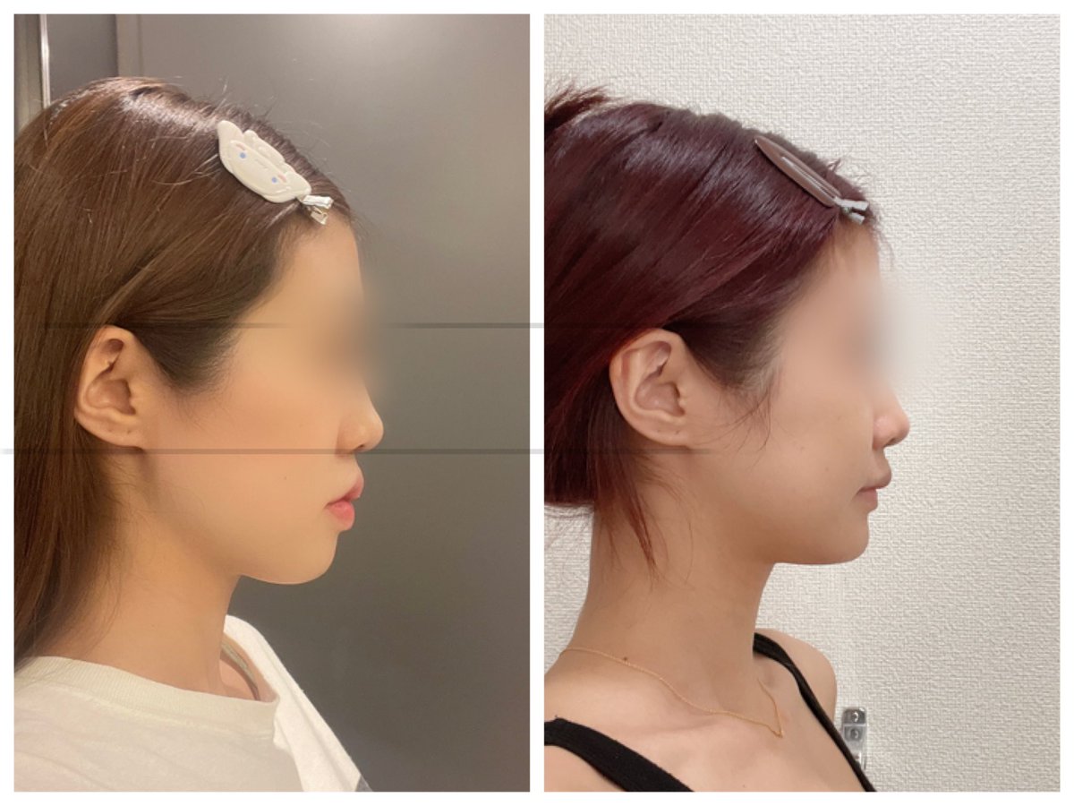 両顎＋輪郭3点 DT4ヶ月半

まだ腫れてる部分あってこれから更にひいてくらしく完成まで長いけど楽しみ😻

やっぱり小鼻は広がっちゃったけど
人中は特に気にならないかな🤔

質問箱再開するので返事遅くてもよければどうぞ🥲💌