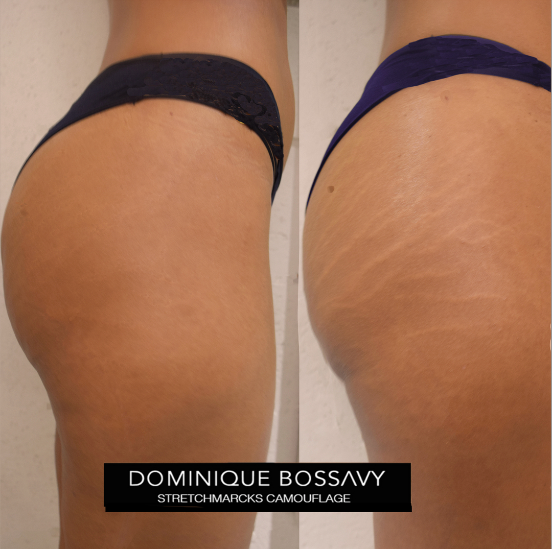 DominiquBossavy's tweet photo. Another rewarding case, of emotional liberation , for this beautiful lady!I #HEALEDresults after 2 sessions,What a transformation! 
My client use to love playing volleyball and spending time at the beach. This was until she got stretchmarks when she was 17 years old. They made he https://t.co/27JWFCgt9X