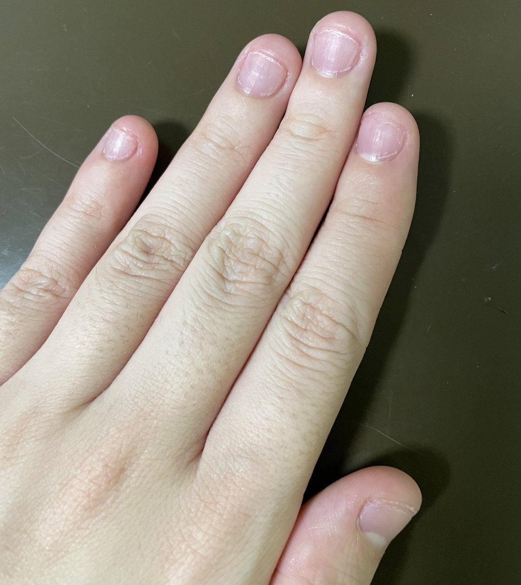 do_without24's tweet photo. 大変お久しぶりです。
新社会人となり、仕事のストレスで爪噛みが再発…
爪噛み癖とは一生付き合っていくものなのだと痛感しました😭
ここから気持ちを新たに #爪噛み 克服開始1日目！
 #深爪 https://t.co/mNwSaD8mov