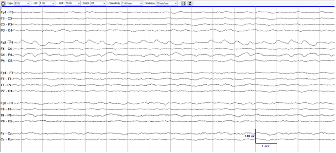 JClinNeurophys's tweet photo. While referencing the @ACNS_org 2021 Guideline (https://t.co/N9p1VGxLQA), Fong et al. investigate the significance of #LRDA with bilateral involvement compared with #GRDA on #EEG in critically ill patients here: https://t.co/PdNlpFJWZp @YaleMed #ClinNeurophys https://t.co/iC2MUcuT56