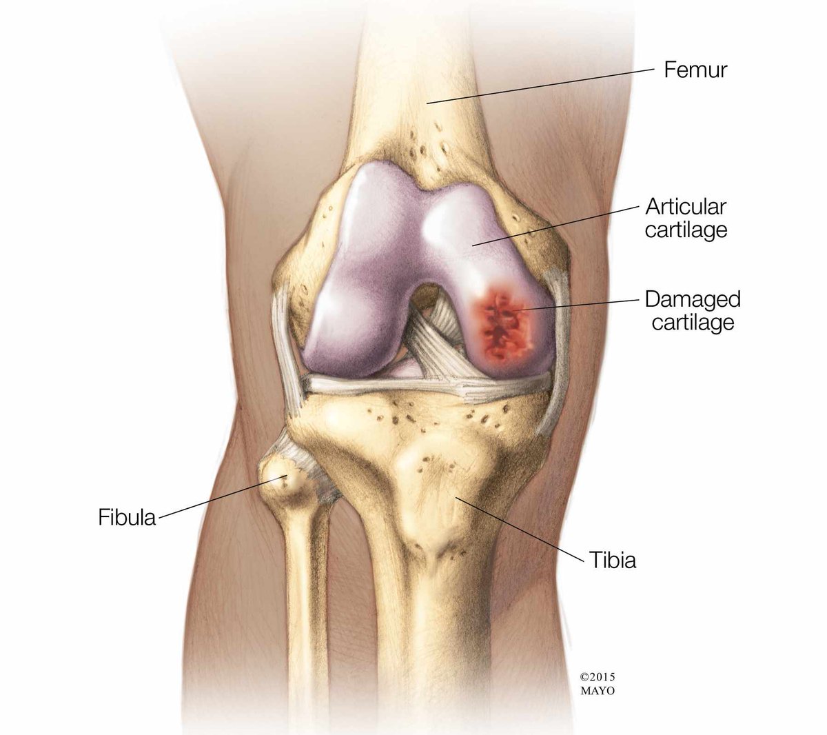 <a href="/MayoClinic/">Mayo Clinic</a> is preparing to launch its first-ever cartilage bank to lay the foundation for a new #regenmed procedure aimed at healing common knee injuries. <a href="/DrKrych/">Dr. Aaron J. Krych</a> <a href="/sarisnl/">Daniël Saris</a> <a href="/MarioHevesiMD/">Mario Hevesi MD PhD</a>
mayocl.in/3jW1xXP