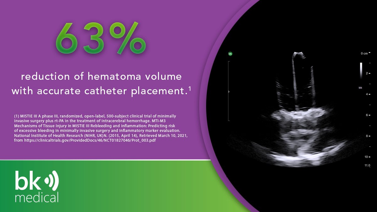 The MISTIE III clinical trial showed a 63% reduction in hematoma volume with accurate catheter placement1.  Intraoperative ultrasound offers real-time guidance for catheter placement. Learn more: hubs.la/H0-8MzZ0 #activereassurance