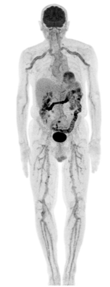 KCLGSTTpet's tweet photo. Extensive LVV inc. bilateral lower limb and extracranial arterial disease. Axial CT, PET and fused PET-CT imaging (proceeding cranially) demonstrates ICA, ECA and vertebral artery uptake, V3 segment uptake (as it loops around C1/C2), ECA uptake in parotids 1/2 https://t.co/31AfVLGZAV
