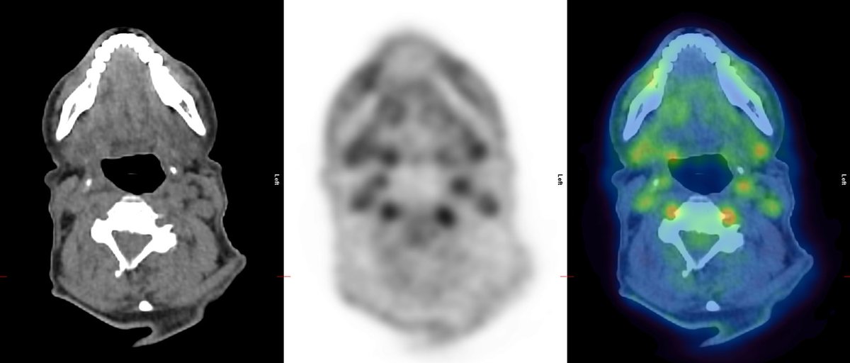 KCLGSTTpet's tweet photo. Extensive LVV inc. bilateral lower limb and extracranial arterial disease. Axial CT, PET and fused PET-CT imaging (proceeding cranially) demonstrates ICA, ECA and vertebral artery uptake, V3 segment uptake (as it loops around C1/C2), ECA uptake in parotids 1/2 https://t.co/31AfVLGZAV