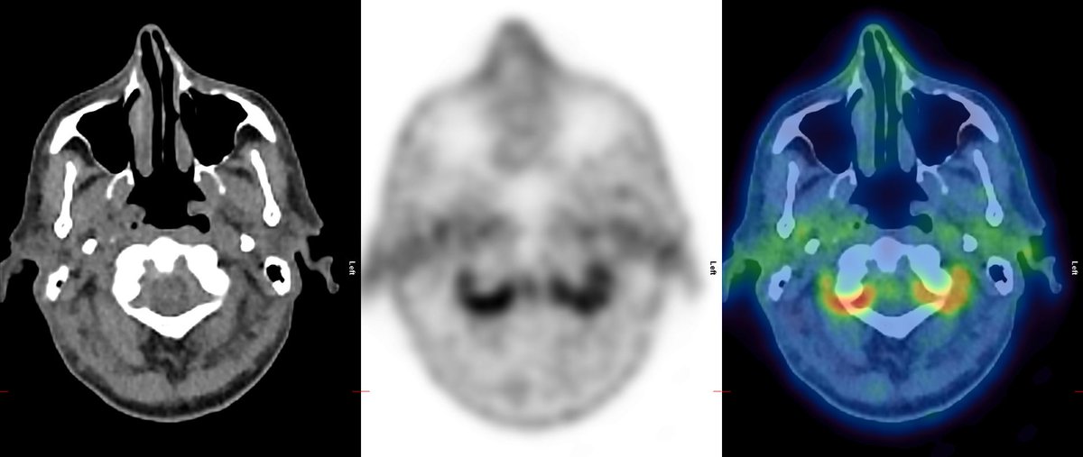 KCLGSTTpet's tweet photo. Extensive LVV inc. bilateral lower limb and extracranial arterial disease. Axial CT, PET and fused PET-CT imaging (proceeding cranially) demonstrates ICA, ECA and vertebral artery uptake, V3 segment uptake (as it loops around C1/C2), ECA uptake in parotids 1/2 https://t.co/31AfVLGZAV