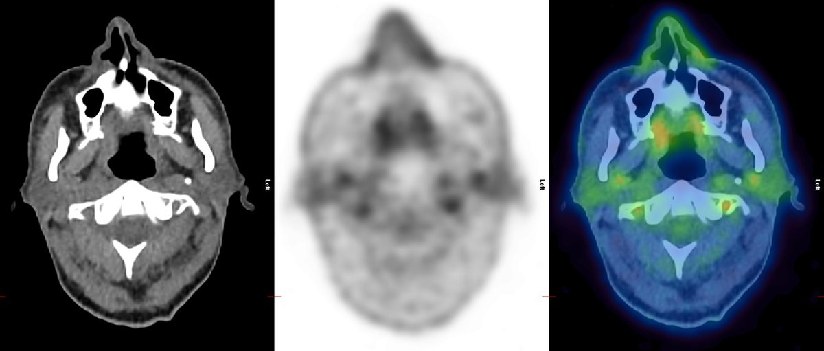 KCLGSTTpet's tweet photo. Extensive LVV inc. bilateral lower limb and extracranial arterial disease. Axial CT, PET and fused PET-CT imaging (proceeding cranially) demonstrates ICA, ECA and vertebral artery uptake, V3 segment uptake (as it loops around C1/C2), ECA uptake in parotids 1/2 https://t.co/31AfVLGZAV
