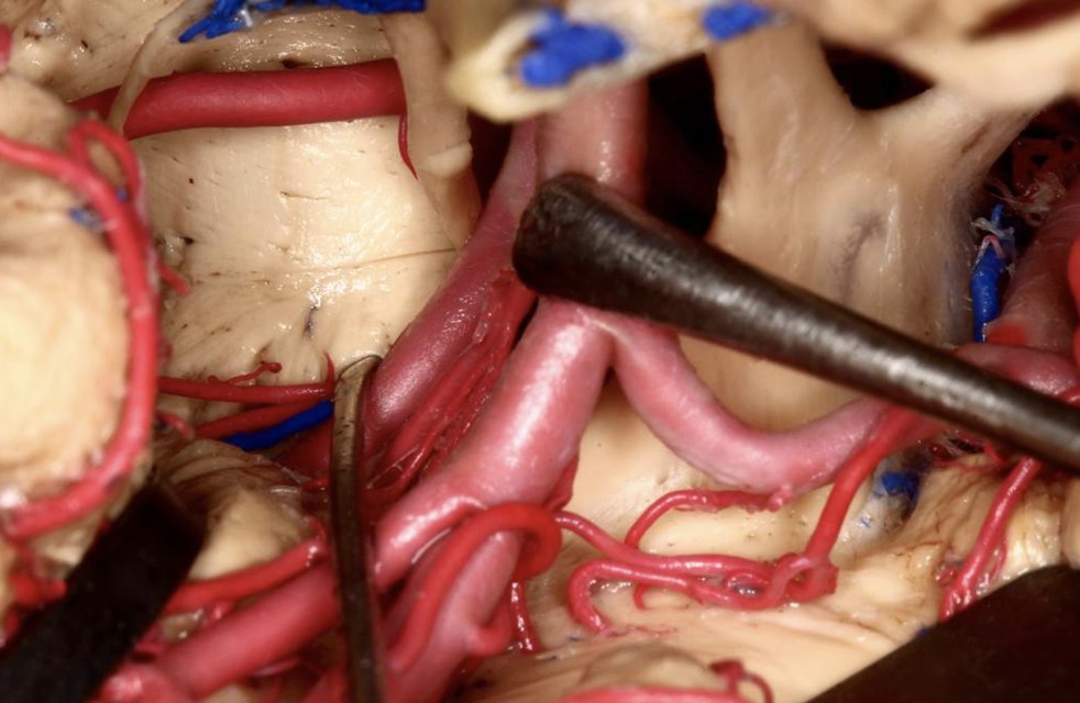 cvsection's tweet image. The anterior #choroidal artery (AChA) emerges from the #ICA  just distal from the #PCOM. Which structures does the #AChA supply? #neuroanatomy Source: @AaronCohenGadol
