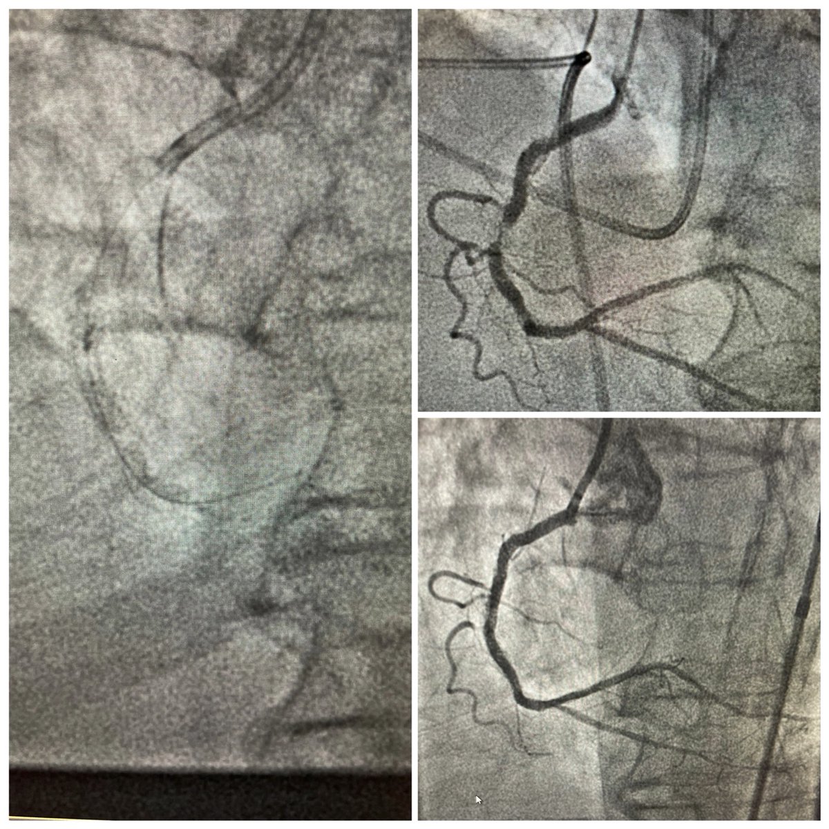 Arasi Maran (@arasimaran) on Twitter photo Thought it to be a calcified lesion- could not image first, proceeded with OA, which stalled. Mangled stent- astutely identified by <a href="/jedmxk/">Marc Kennedy</a>, wisely adviced by <a href="/DrBillLombardi/">Dr. Bill Lombardi</a> to stent over it. All is good <a href="/mevansMD/">Matt Evans</a> <a href="/skyazim/">Sayyad Kyazimzade, MD, MPH</a> <a href="/SanjogKalra/">Sanjog Kalra</a> <a href="/perc_surgeon/">Robert Riley</a> Thought it to be a calcified lesion- could not image first, proceeded with OA, which stalled. Mangled stent- astutely identified by <a href="/jedmxk/">Marc Kennedy</a>, wisely adviced by <a href="/DrBillLombardi/">Dr. Bill Lombardi</a> to stent over it. All is good <a href="/mevansMD/">Matt Evans</a> <a href="/skyazim/">Sayyad Kyazimzade, MD, MPH</a> <a href="/SanjogKalra/">Sanjog Kalra</a> <a href="/perc_surgeon/">Robert Riley</a>