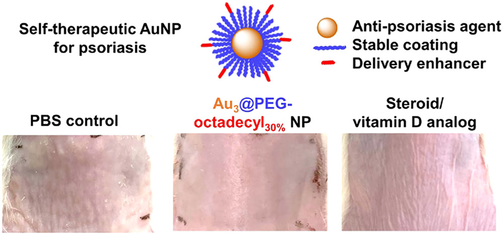 NanoLetters's tweet photo. New work from @jchchoilab @CUHKBME @CUHKengineering: Sub-15 nm alkyl-terminated #gold #nanoparticles, without known chemical or biological drugs, are self-therapeutic #nanomedicines for #psoriasis. https://t.co/UOOiUfjleZ /#NLAR https://t.co/RR3UkBytrH