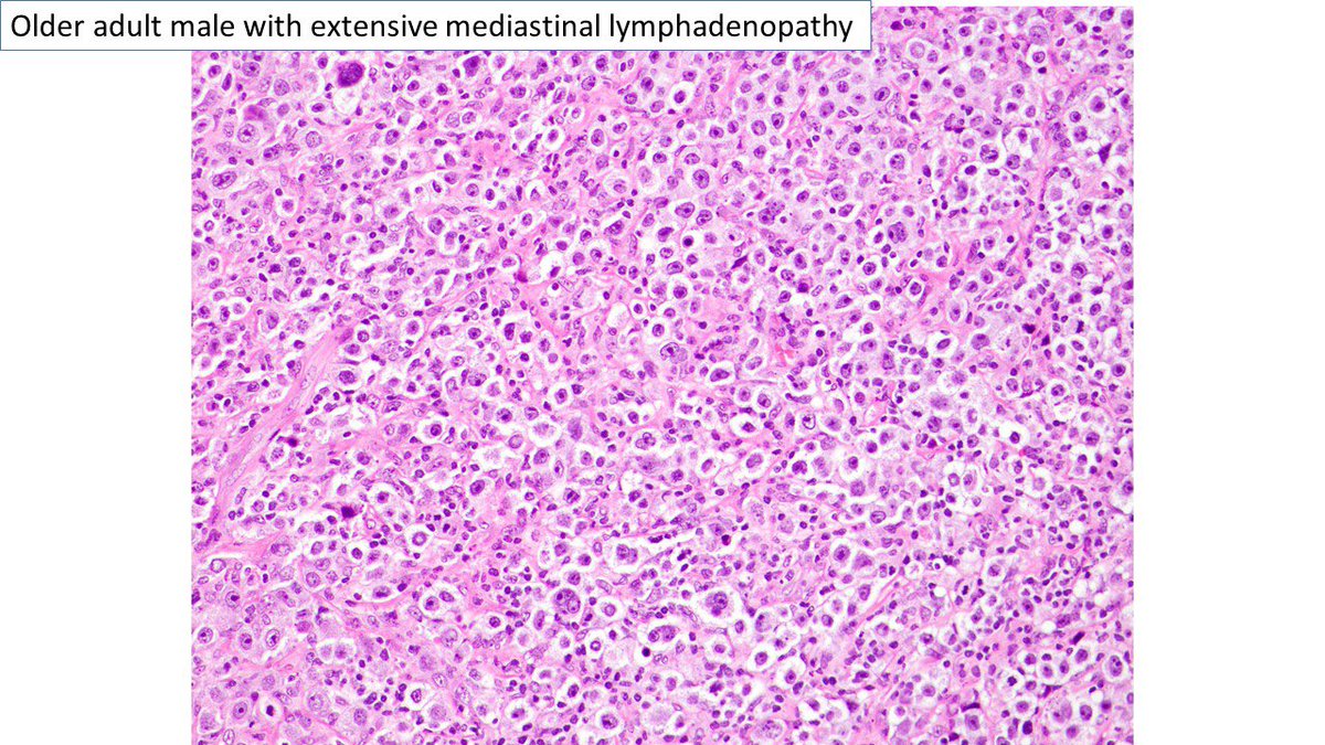 judith_ferry's tweet photo. Pathologists! Here’s a mediastinal gray-zone lymphoma: sheets of tumor cells with morphology more like non-Hodgkin lymphoma (though with few RS-like cells) &amp; immunophenotype more like classic Hodgkin lymphoma. #hemepath #lymphoma #mediastinum. https://t.co/wPlEusdWuO