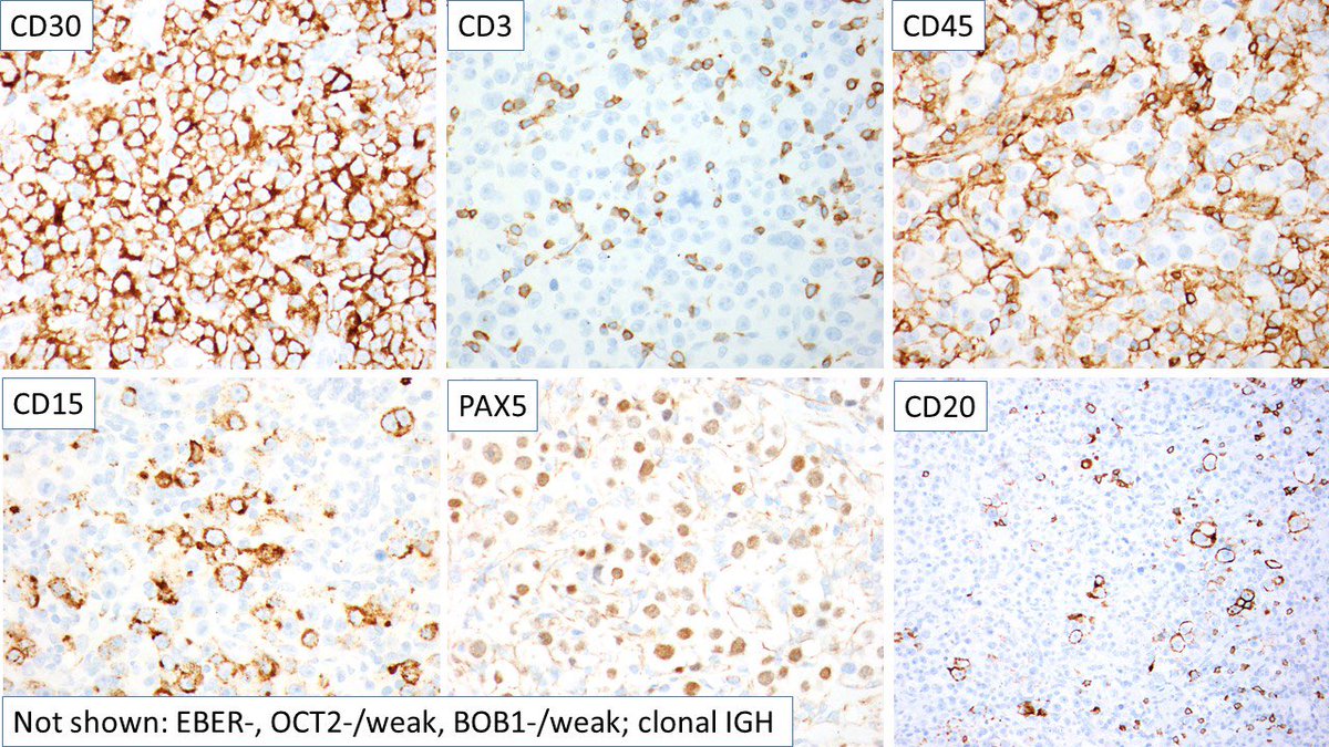 judith_ferry's tweet photo. Pathologists! Here’s a mediastinal gray-zone lymphoma: sheets of tumor cells with morphology more like non-Hodgkin lymphoma (though with few RS-like cells) &amp; immunophenotype more like classic Hodgkin lymphoma. #hemepath #lymphoma #mediastinum. https://t.co/wPlEusdWuO