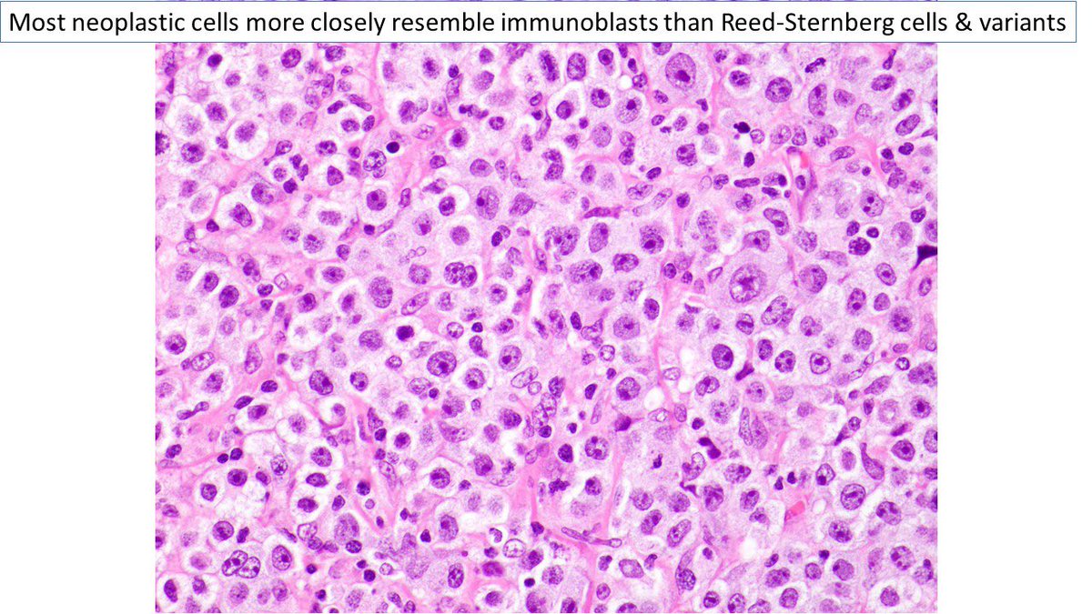 judith_ferry's tweet photo. Pathologists! Here’s a mediastinal gray-zone lymphoma: sheets of tumor cells with morphology more like non-Hodgkin lymphoma (though with few RS-like cells) &amp; immunophenotype more like classic Hodgkin lymphoma. #hemepath #lymphoma #mediastinum. https://t.co/wPlEusdWuO