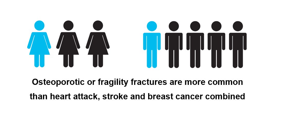 One in five men, and one in three women over the age of 50 will have an osteoporotic fracture in their lifetime.