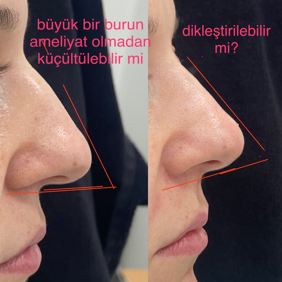 SehriyarDr's tweet photo. Nonsurgical rhinoplasty means correction of deformitis of the nose without any surgical intervention. Its generally done by injecting dermal filler to the nose. https://t.co/a6kGahLHGE