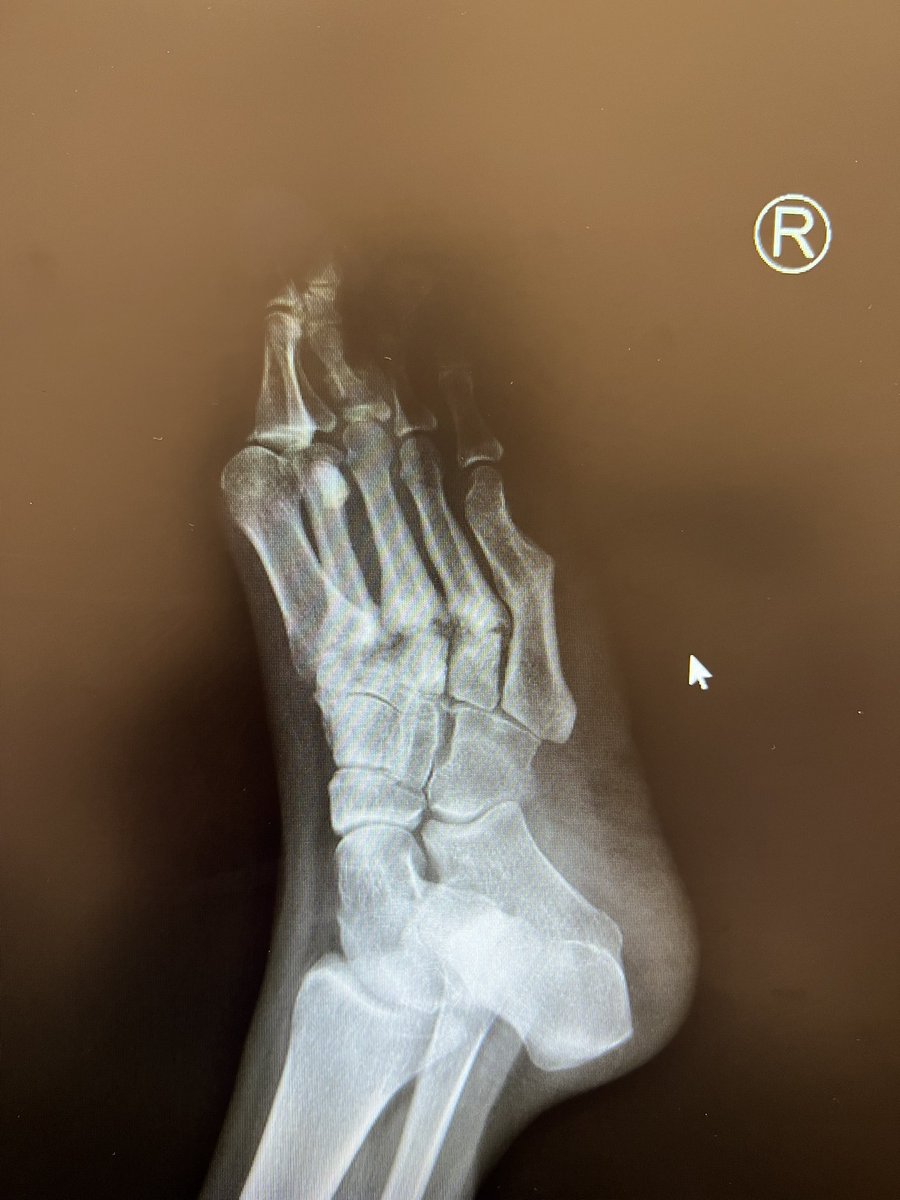 MedorthoMs's tweet photo. 57 Y female. DM type l . Community mobilizer without assistance.Came to me with this progressive foot deformity. @BostonFootAnkle @NYCDoctorV @bemooremd https://t.co/EPnVpK1jUK