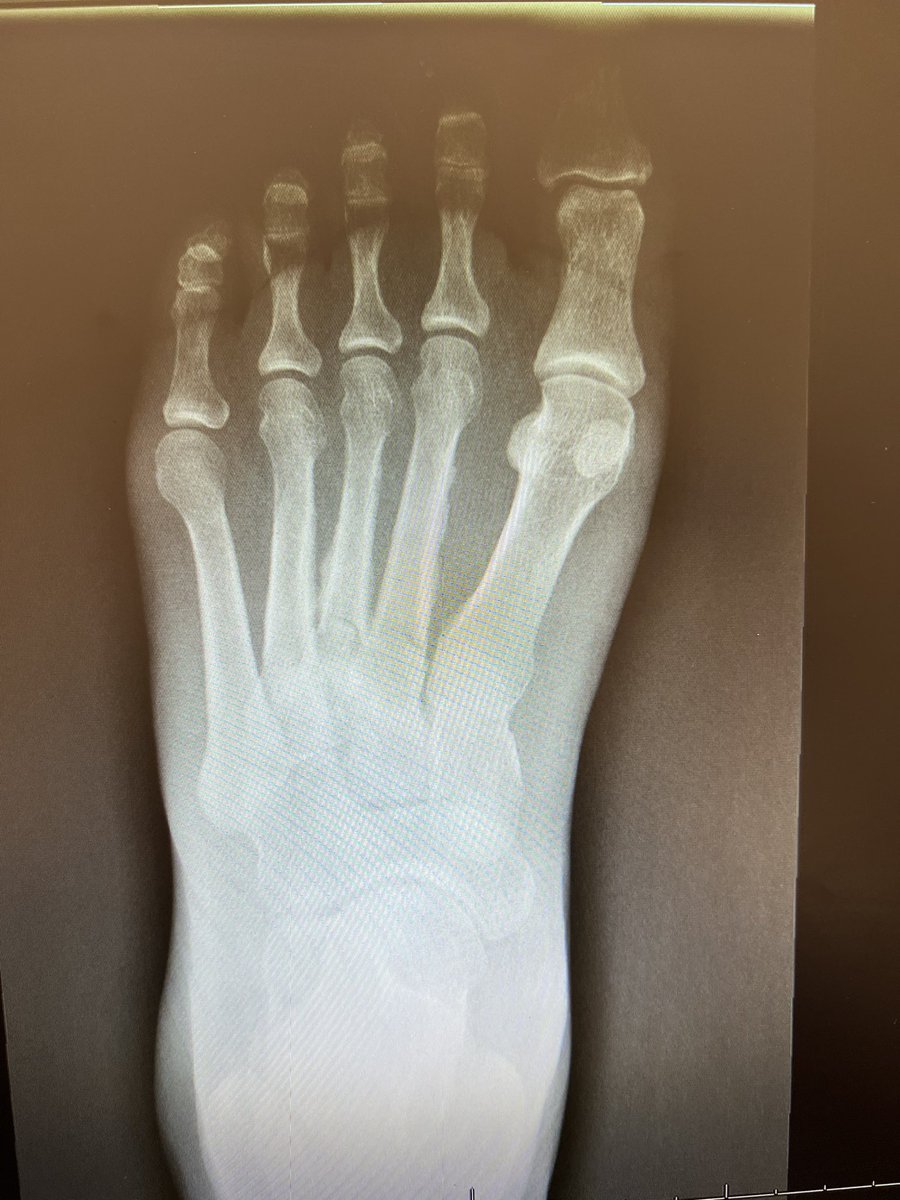 MedorthoMs's tweet photo. She was following In Other hospital for one year .
Her initial X-ray was this :
Any idea? https://t.co/lLKdGfdpOF