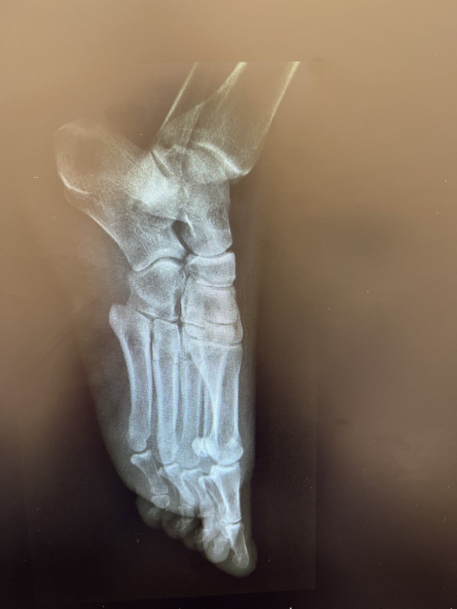 MedorthoMs's tweet photo. She was following In Other hospital for one year .
Her initial X-ray was this :
Any idea? https://t.co/lLKdGfdpOF