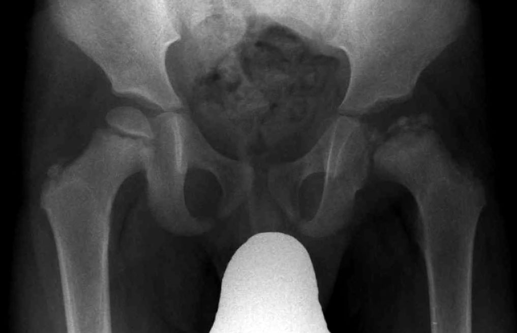 It's not always the apophyses

Be vigilant for red flag conditions eg Perthes (5-10) &amp; SUFE (10-15) - missing these can condemn the child to accelerated loss of function, OA, (and early hip replacement in adulthood). Needs ortho input.

Knee pain? THINK HIP &amp; EXAMINE IT!