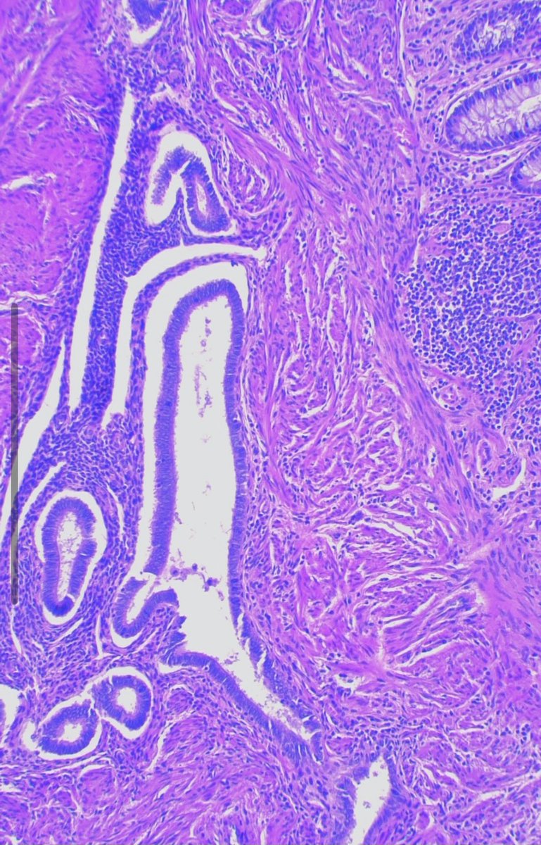 JCandidoXavier's tweet photo. BOWEL ENDOMETRIOSIS - I cannot even imagine how suffering it could be.

#endometriosis #gipatg #gypath #surgpath #womenhealth #path https://t.co/XWIfpNrnZm