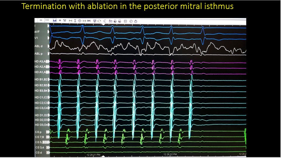 In this interesting case of mitral flutter we were surprised by how proximal the VOM was in the CS with venography. Luckily we had a guide! Thanks @MiguelVldrbno @MichaelCoMD @AbbottCardio @TJHeartFellows sciencedirect.com/science/articl…