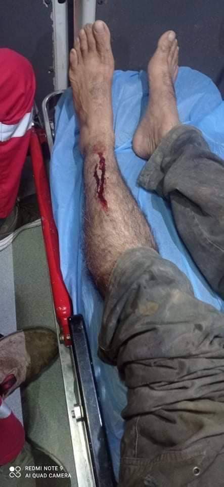 Leg injury sustained by Arab during violence near Mitzpe Yair.