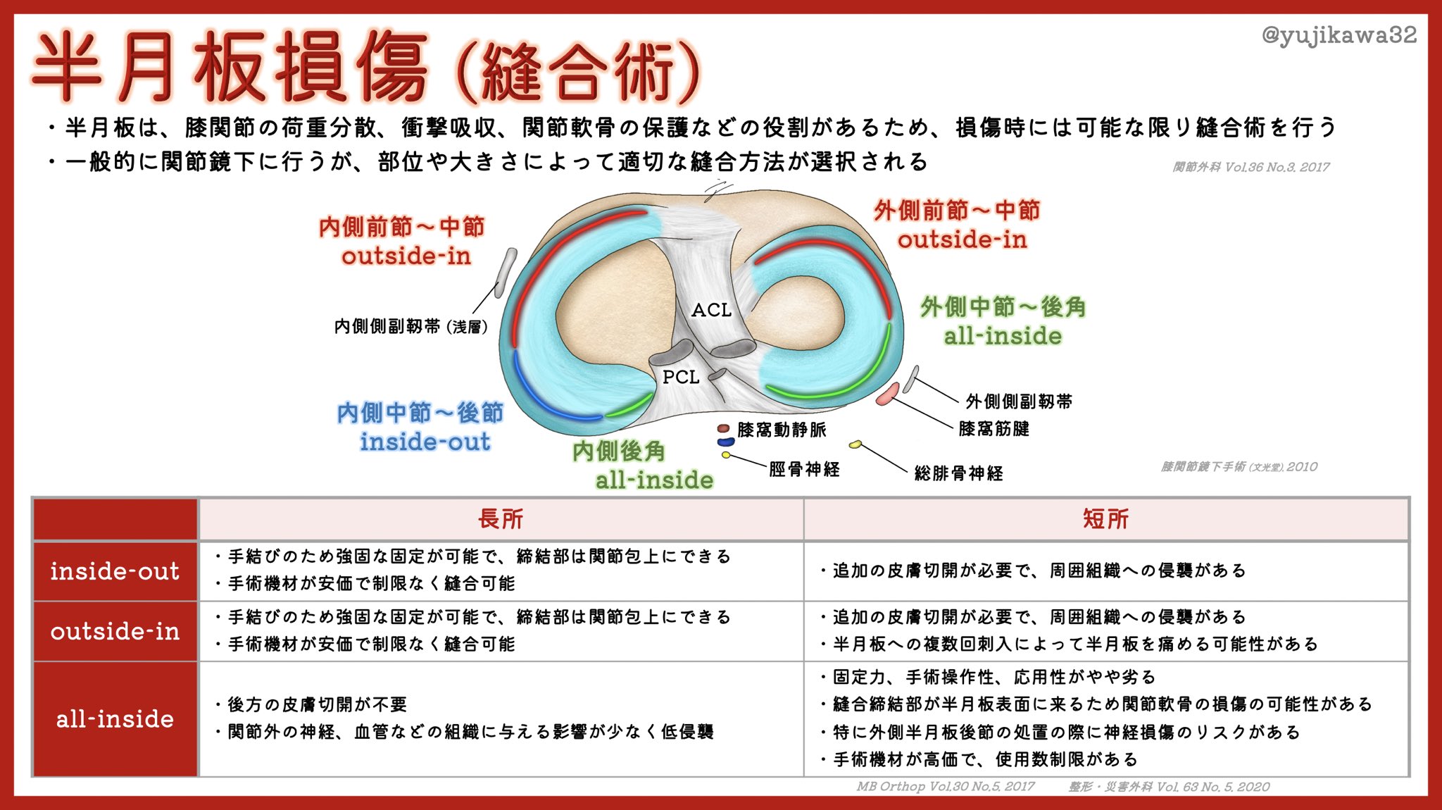 ユジカワ 整形dr イラストレーター 半月板縫合についてまとめました 代表的な縫い方として 関節包に対して中から外 Inside Out 外から中 Outside In 全部関節鏡で済ませる All Inside の3種類がある 図は参考程度 半月板損傷 半月板縫合術 ユジカワ 整形dr イラストレーター 半月板縫合についてまとめました 代表的な縫い方として 関節包に対して中から外 Inside Out 外から中 Outside In 全部関節鏡で済ませる All Inside の3種類がある 図は参考程度 半月板損傷 半月板縫合術