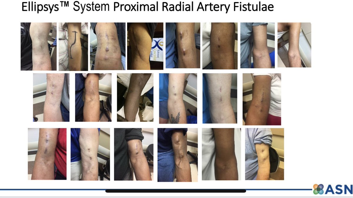 NMawlaMD's tweet photo. Summary of the 5yr data from the Ellipsys Pivotal Trial presented by Dr Hull at ASN Kidney Week. It’s eye opening to say the least. @ASNKidney @ASDINNews #Ellipsys #endoAVF #pAVF #kidneywk #nephtwitter https://t.co/cvNuBlSWst