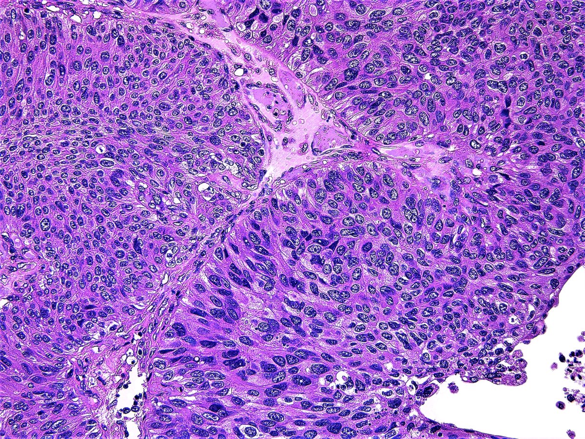 Urothelial carcinoma, TUR-Bt. #Pathology #Pathologist #UroPath