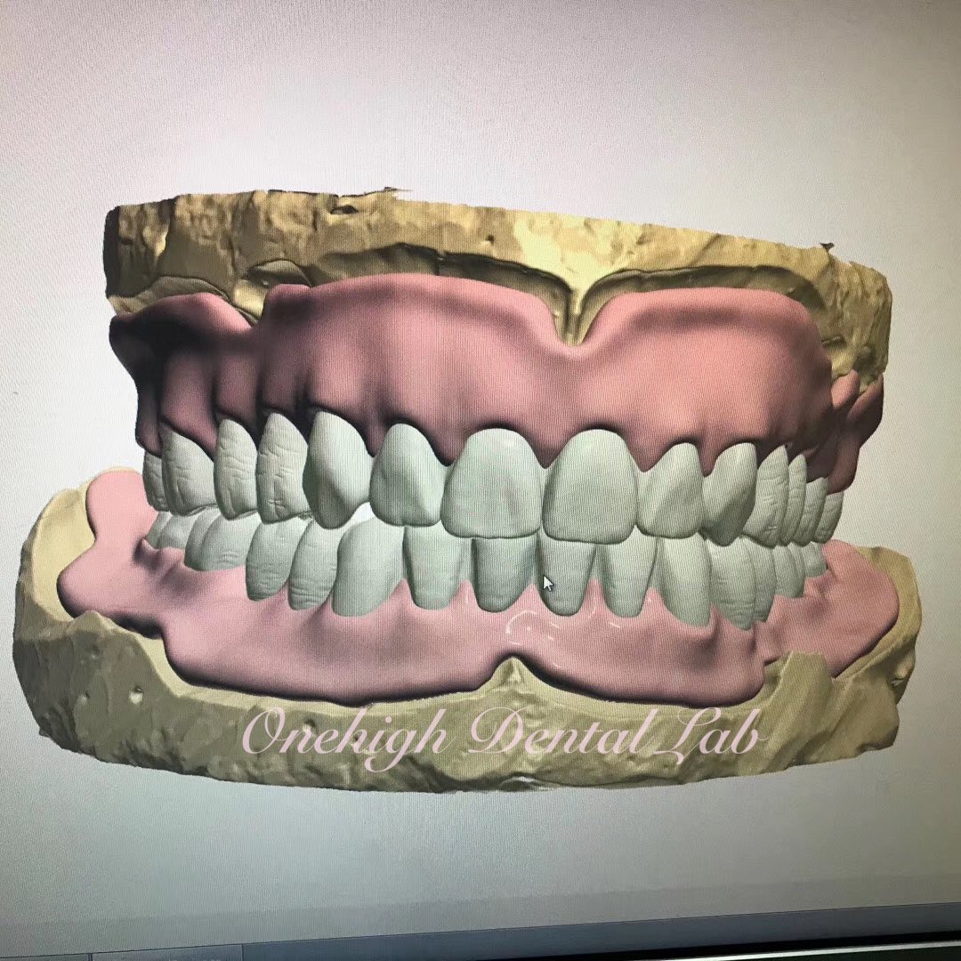 RosaOnehigh's tweet photo. Removable Partial Denture Design
Framework design
Framework with Casting Rod design
Flexible partial design
Full denture design
WhatsApp 008613507205237
#dentaldesign
#dentalcadsolved
#3shapedesign
#exocaddesigns
#frameworkdesigns
#partialdenturedesign
#dentaldesign https://t.co/DnZXQzPzXW