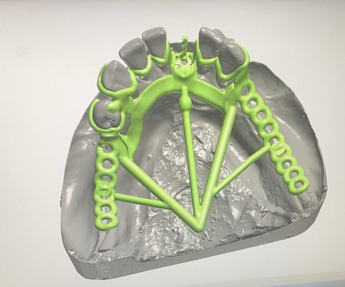 RosaOnehigh's tweet photo. Removable Partial Denture Design
Framework design
Framework with Casting Rod design
Flexible partial design
Full denture design
WhatsApp 008613507205237
#dentaldesign
#dentalcadsolved
#3shapedesign
#exocaddesigns
#frameworkdesigns
#partialdenturedesign
#dentaldesign https://t.co/DnZXQzPzXW
