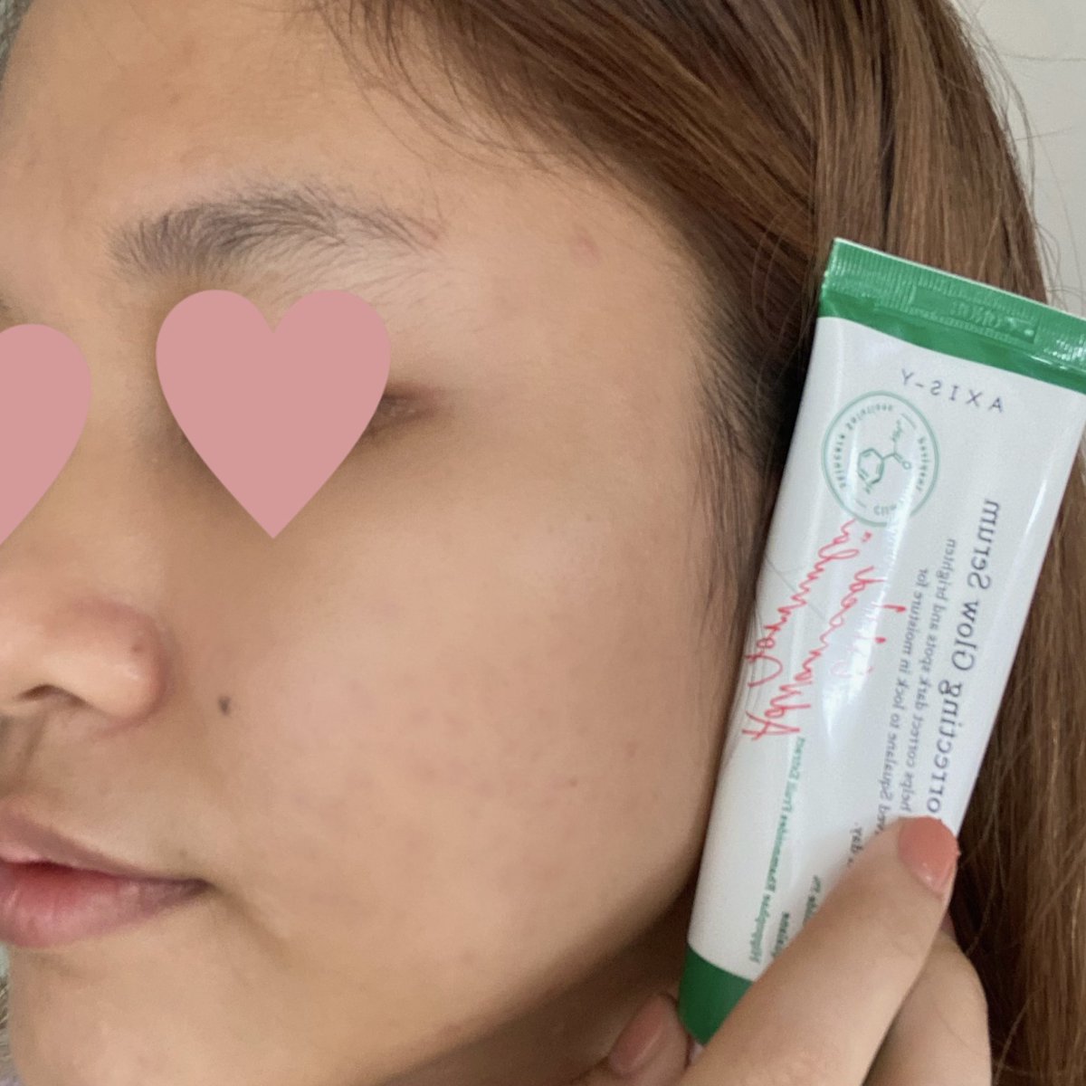 bckupacc99's tweet photo. GUYS! I DAH JUMPA SERUM SETANDING THE ORDINARY.

bila pakai TO ada yang tak sesuai dengan kulit kan? Then naik jerawat lah, kulit purging lah. Kalau skin korang mengada macam ni, cuba Axis Y Serum settle masalah. Auto tak breakout langsung!😙 

Before:                      After: https://t.co/jmYUqvimlv