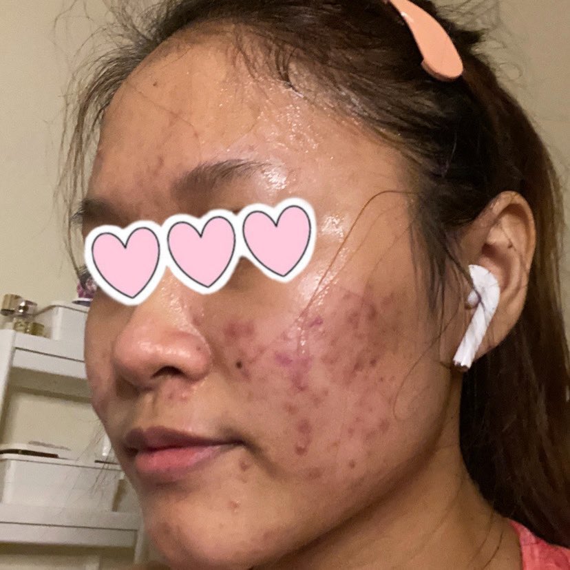 bckupacc99's tweet photo. GUYS! I DAH JUMPA SERUM SETANDING THE ORDINARY.

bila pakai TO ada yang tak sesuai dengan kulit kan? Then naik jerawat lah, kulit purging lah. Kalau skin korang mengada macam ni, cuba Axis Y Serum settle masalah. Auto tak breakout langsung!😙 

Before:                      After: https://t.co/jmYUqvimlv