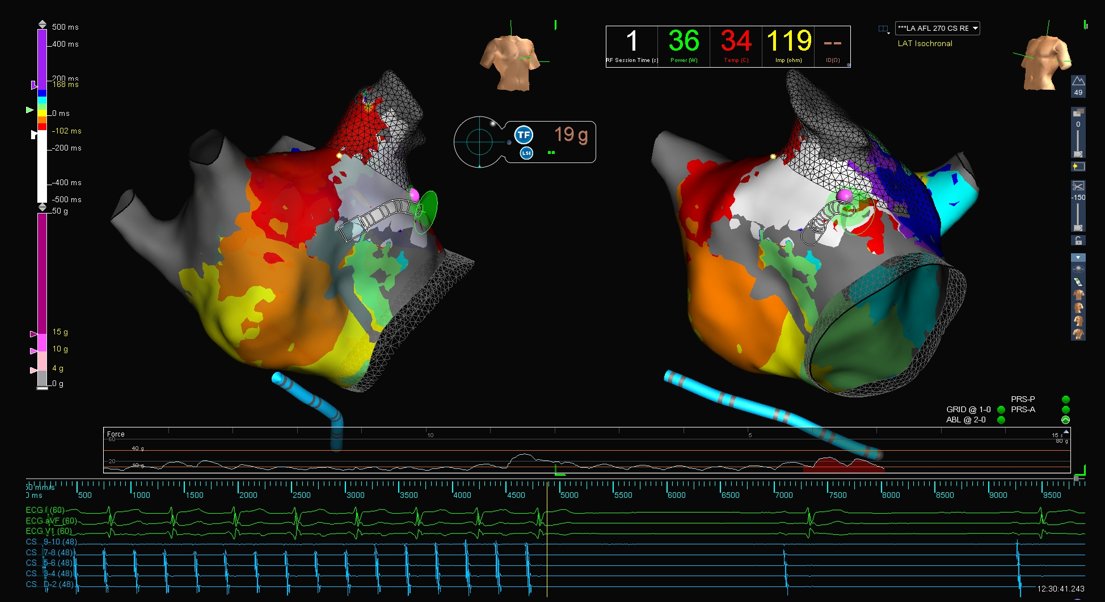 WongChrisX's tweet photo. Interesting 4th re-do from OSH for incessant AFL

Peri-mitral flutter utilizing isthmus between previously isolated LAA and mitral annulus

Great maps by @mmccormickhinds

#EPeeps https://t.co/AHOYJrO58p