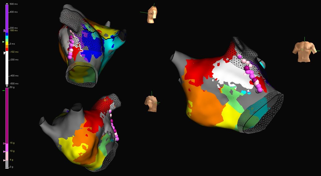WongChrisX's tweet photo. Interesting 4th re-do from OSH for incessant AFL

Peri-mitral flutter utilizing isthmus between previously isolated LAA and mitral annulus

Great maps by @mmccormickhinds

#EPeeps https://t.co/AHOYJrO58p