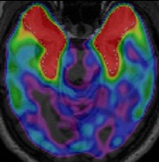 Brain1878's tweet image. Levy et al. show binding of [18F]MK-6240 in patients with FTD caused by tau mutations, and minimal non-specific binding in FTD caused by non-tau mutations, implying a promising degree of specificity. bit.ly/3vr2fkn
