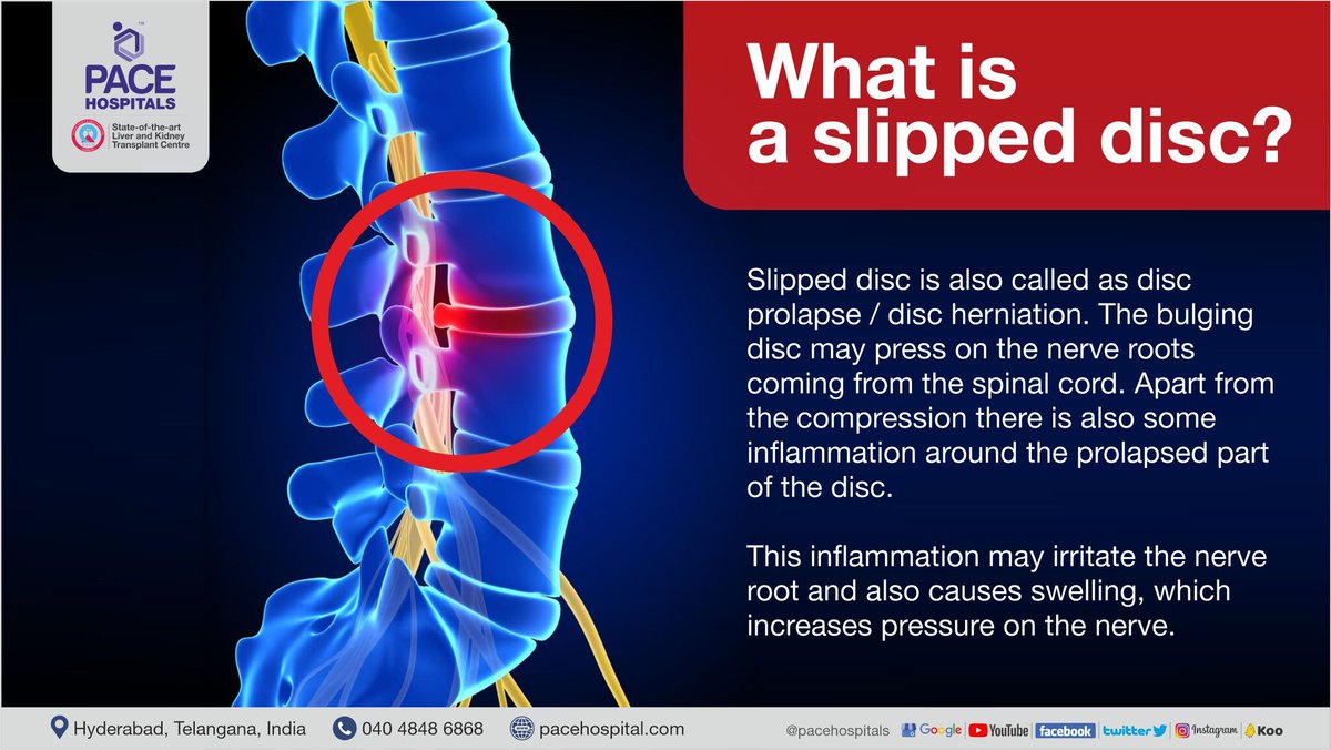 PACEHospitals's tweet photo. Slipped disc is also called as disc prolapse / disc herniation. The bulging disc may press on the nerve roots coming from the spinal cord. https://t.co/JvjQWz6xFI
#herniateddisc #backpain #slippeddisc #discprolapse #sciatica #pacehospitals #neckpain #lowbackpain #health https://t.co/EIJrx64atk