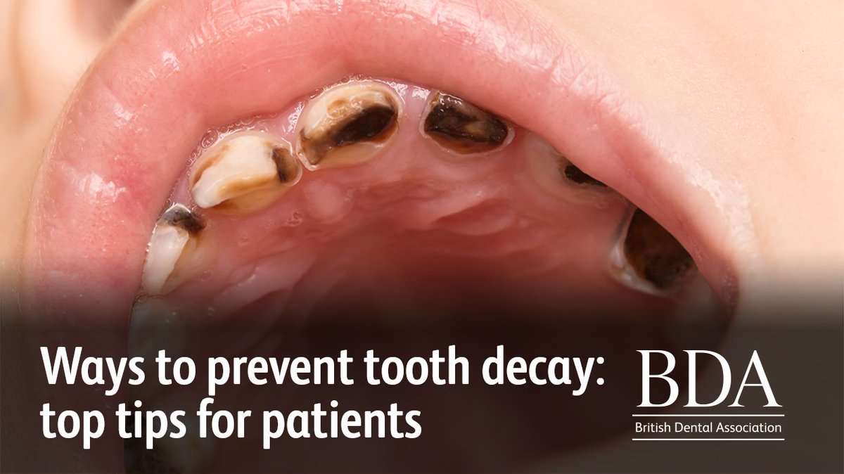 TheBDA's tweet photo. 🦷 Tooth decay remains the number one reason for hospital admissions among young children. 

Here are top tips you can share with your patients to protect their teeth: https://t.co/4CPz8enuyr 

#SugarAwarenessWeek https://t.co/NU5KGyMJzU