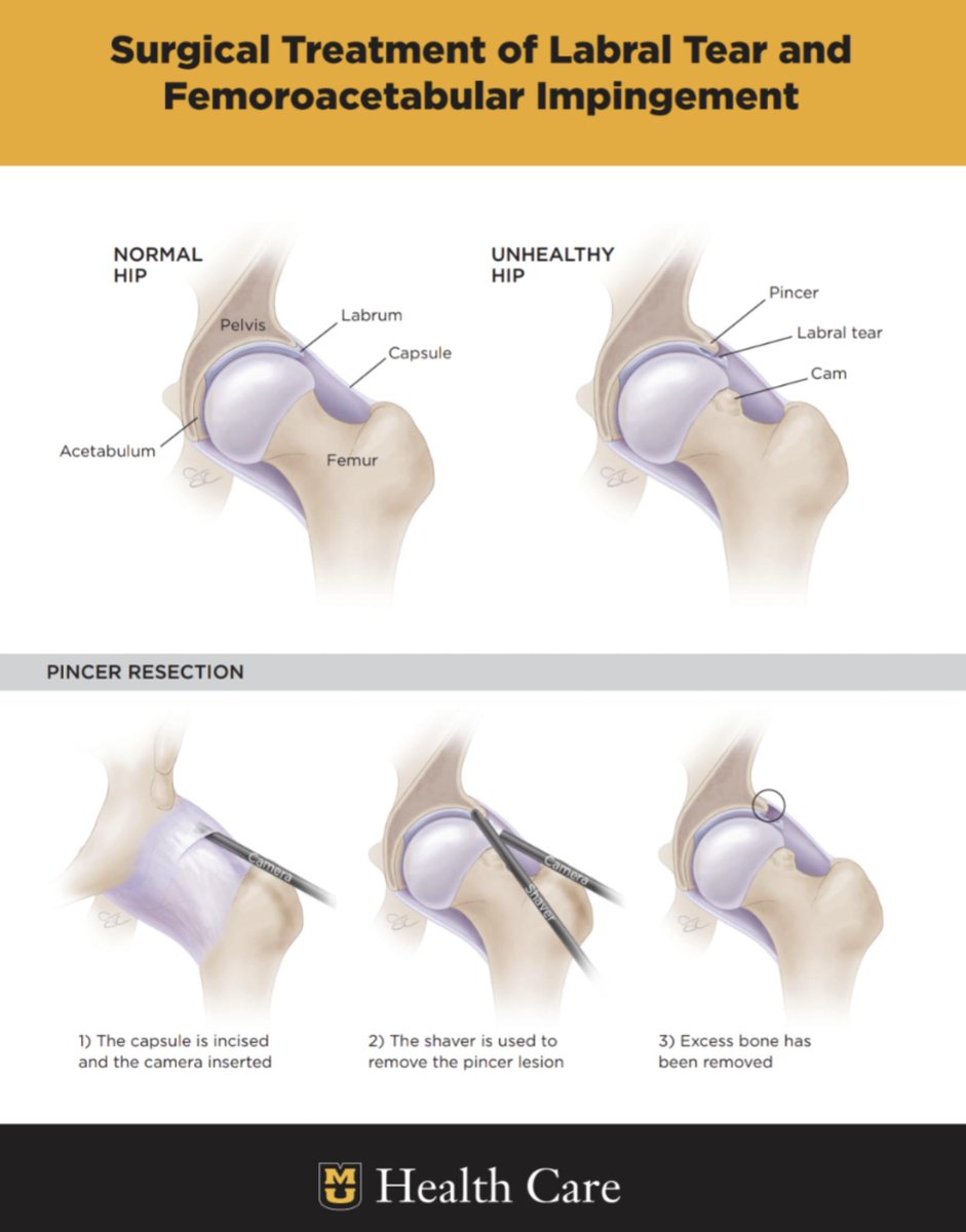 MizzouOrtho's tweet photo. Hip pain? You may have femoracetabular impingement (FAI) which can cause labral tear. Luckily that's one of the many conditions we treat @MUOrthopaedic and @muhealth. See below for how treat this with minimally invasive surgery! #savethehip #hipscope #FAI #labrum #MIZ #hiphip https://t.co/L7FHTxo0i0