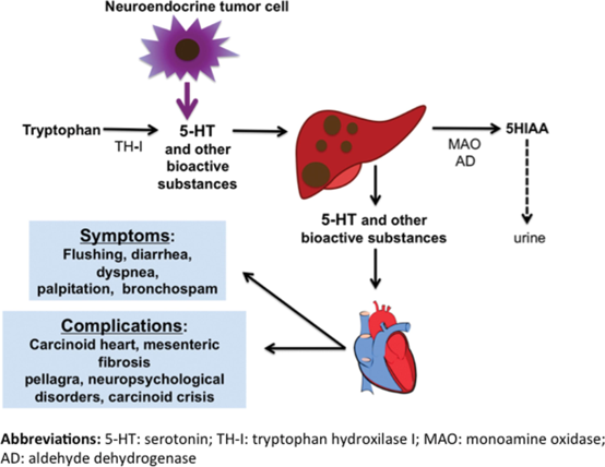 American Association of Endocrine Surgeons (@theaaes) on Twitter photo Carcinoid syndrome can occur from metastatic NETs that produce serotonin. The symptoms include flushing, diarrhea, bronchoconstriction, and right-sided heart failure.
#NETAM2021 #NeuroendocrineTumor #LetsTalkAboutNETs
<a href="/NANETS1/">NANETS</a> <a href="/CarcinoidNETs/">CarcinoidCancer CCF</a> @LACNETS <a href="/PheoPara/">Pheo Para Alliance</a> Carcinoid syndrome can occur from metastatic NETs that produce serotonin. The symptoms include flushing, diarrhea, bronchoconstriction, and right-sided heart failure.
#NETAM2021 #NeuroendocrineTumor #LetsTalkAboutNETs
<a href="/NANETS1/">NANETS</a> <a href="/CarcinoidNETs/">CarcinoidCancer CCF</a> @LACNETS <a href="/PheoPara/">Pheo Para Alliance</a>