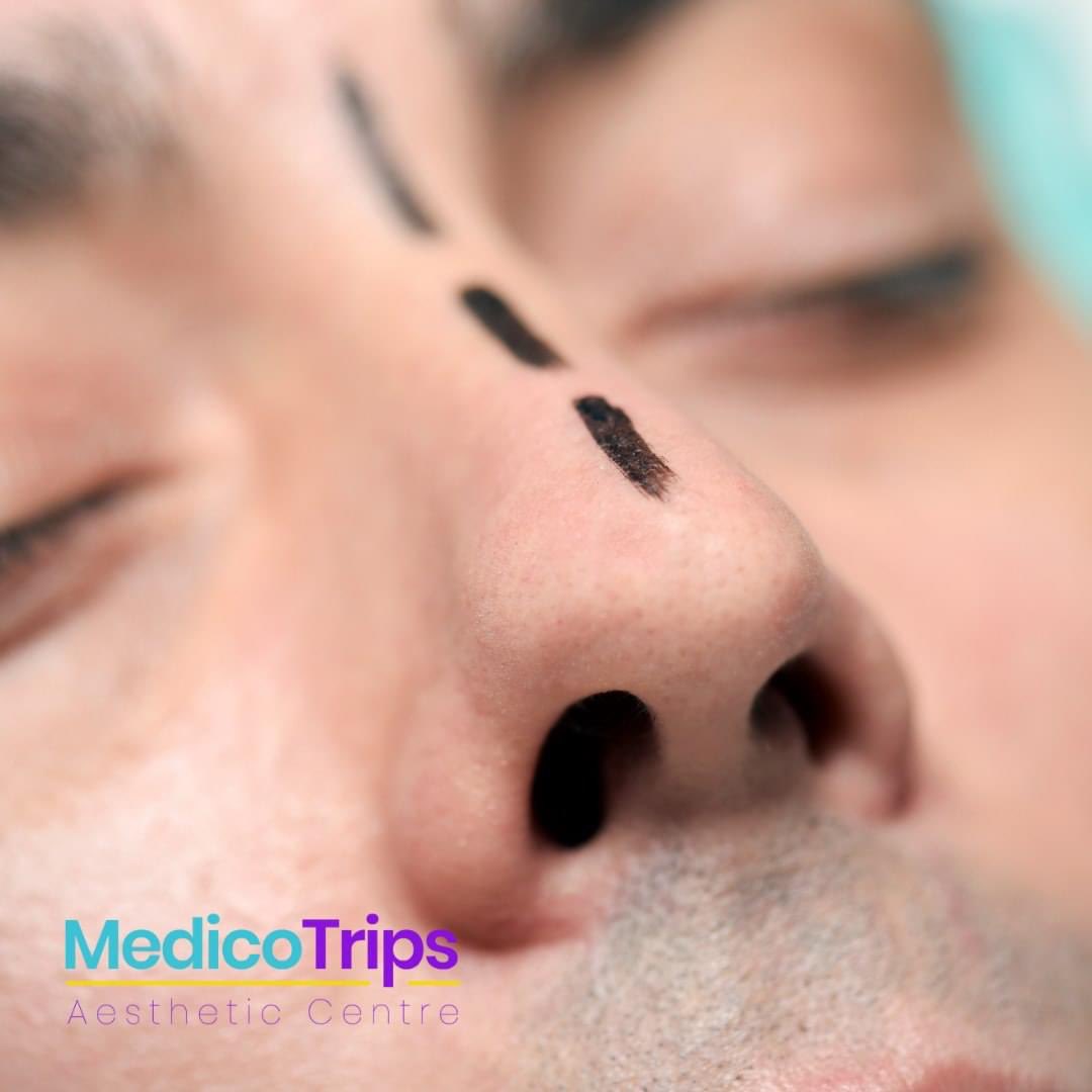 medicotrips's tweet photo. At MedicoTrips, we believe everyone deserves to feel confident in their own skin and we're here to help make that dream a reality!
Find out more about the nose job procedure here: https://t.co/HDZGyKNmQy π
#rhinoplasty #nosejob #nosereshape #aestheticsurgery #nosecorrection https://t.co/rQCH72BQ5P
